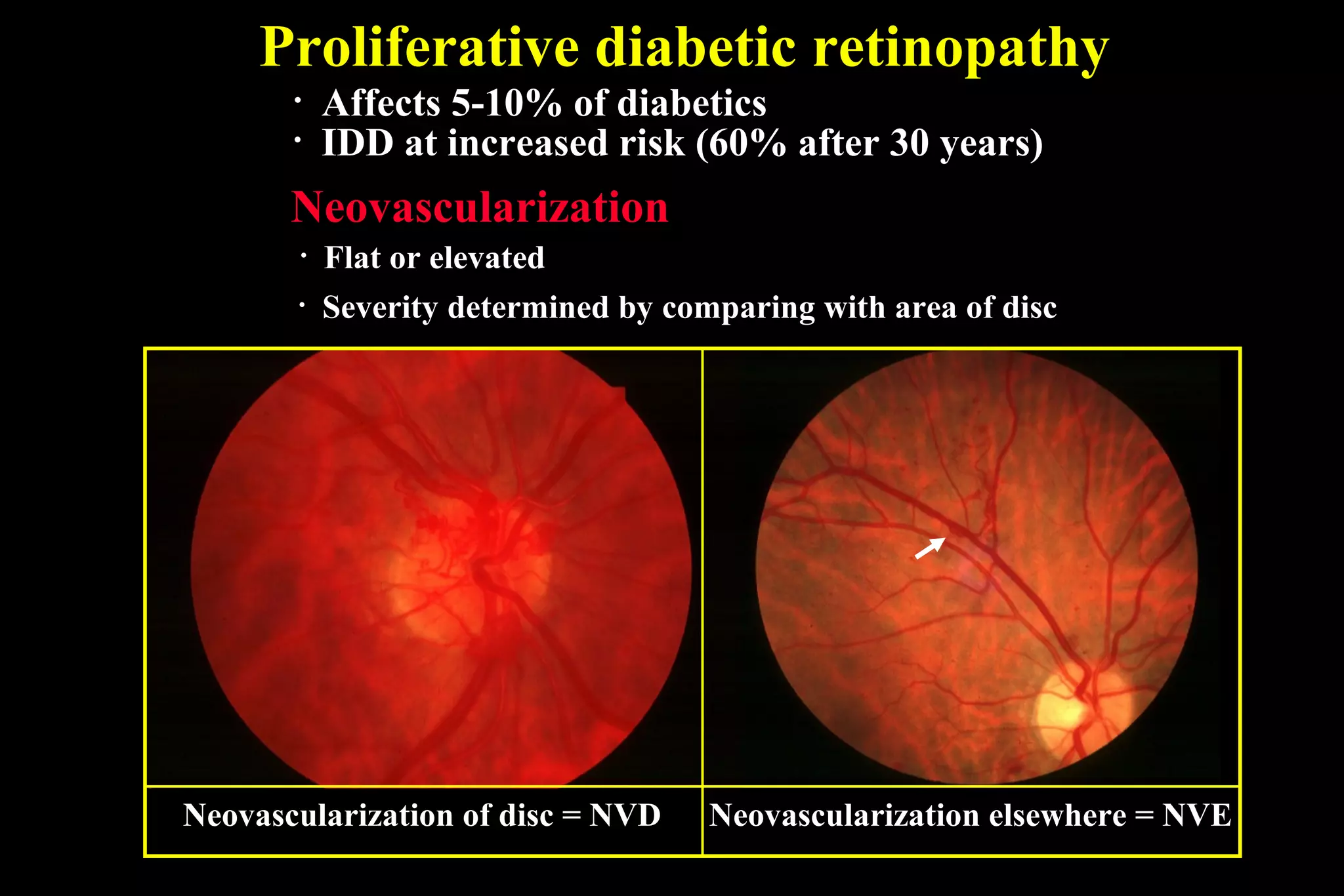 Proliferative diabetic retinopathy
• Flat or elevated
• Severity determined by comparing with area of disc
Neovascularization
Neovascularization of disc = NVD
• Affects 5-10% of diabetics
• IDD at increased risk (60% after 30 years)
Neovascularization elsewhere = NVE
 