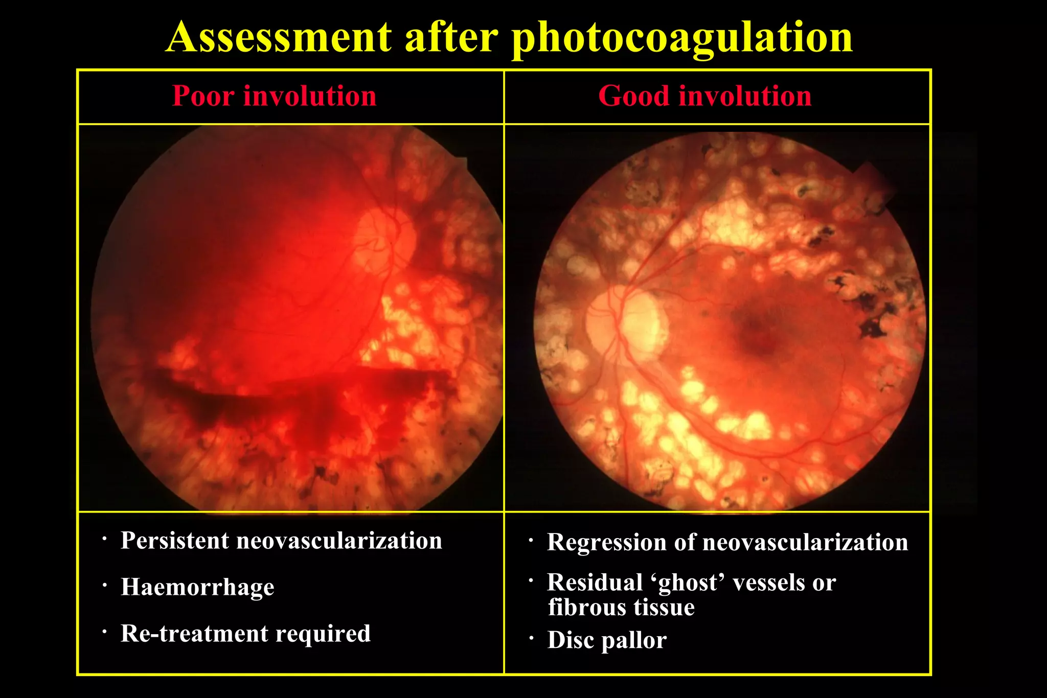 Assessment after photocoagulation
• Persistent neovascularization
• Haemorrhage
Poor involution
• Re-treatment required
• Regression of neovascularization
• Residual ‘ghost’ vessels or
fibrous tissue
Good involution
• Disc pallor
 