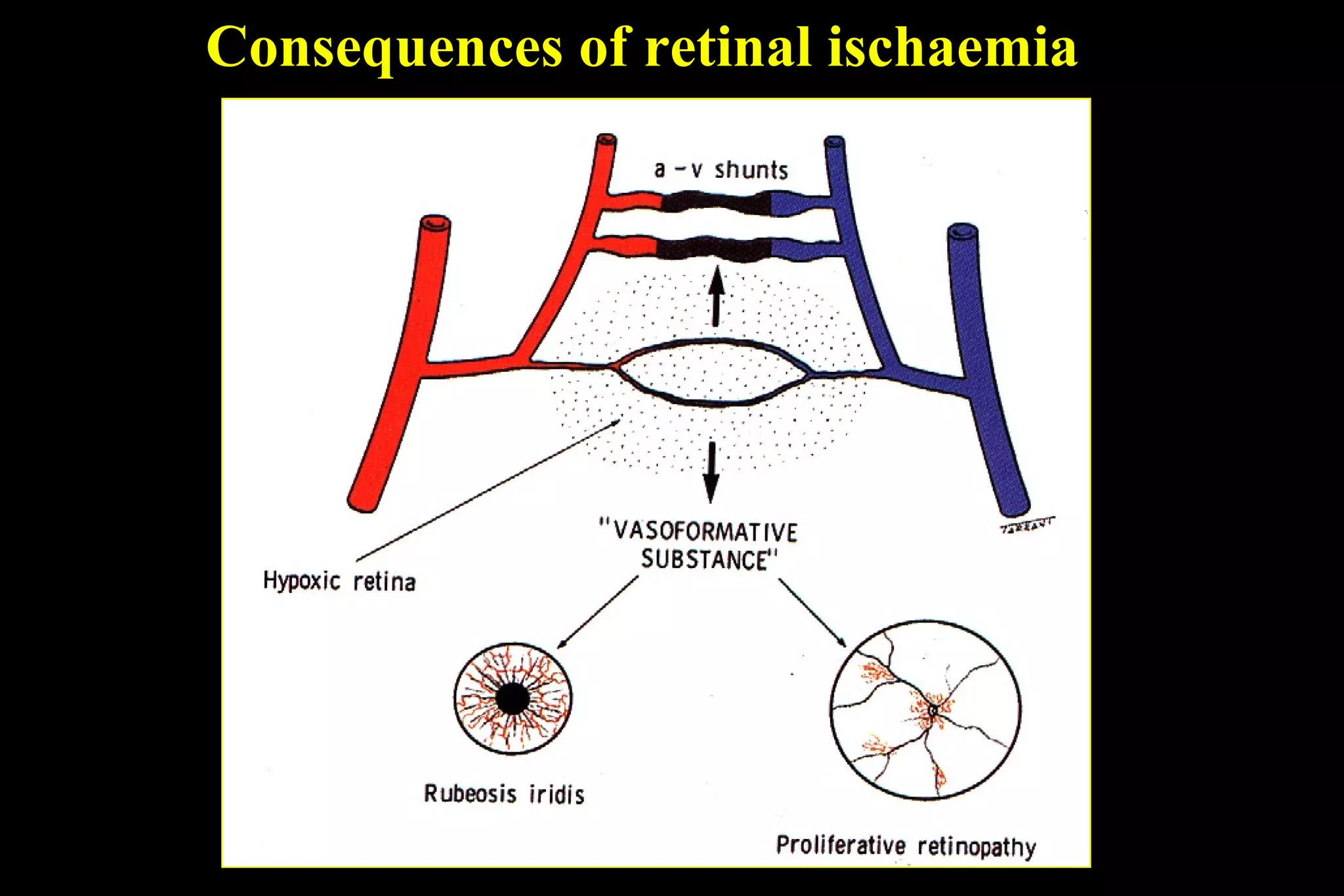 Consequences of retinal ischaemia
 