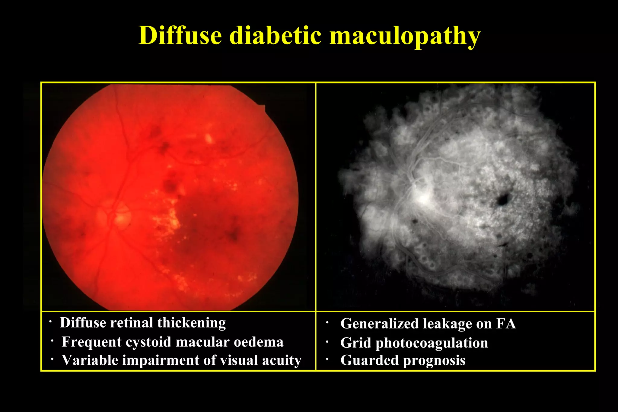 Diffuse diabetic maculopathy
• Diffuse retinal thickening • Generalized leakage on FA
• Guarded prognosis
• Grid photocoagulation• Frequent cystoid macular oedema
• Variable impairment of visual acuity
 