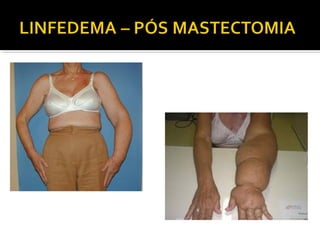 Semiologia dos Edemas