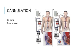 CANNULATION
Bi-caval
Dual lumen
 