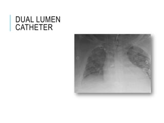 DUAL LUMEN
CATHETER
 