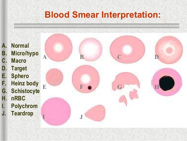 4a..hemolytic anemia