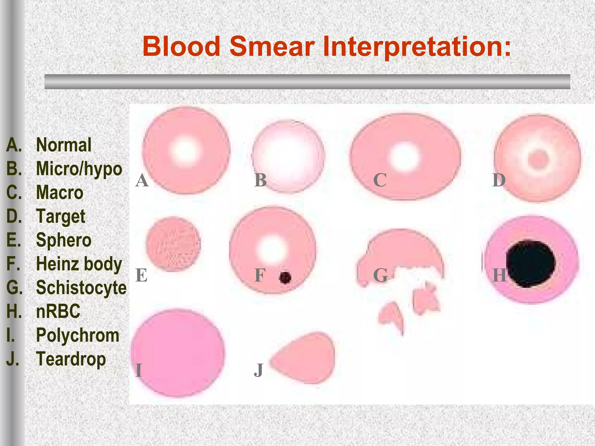 Blood Smear Interpretation:
A B C D
E F G H
I J
A. Normal
B. Micro/hypo
C. Macro
D. Target
E. Sphero
F. Heinz body
G. Schistocyte
H. nRBC
I. Polychrom
J. Teardrop
 
