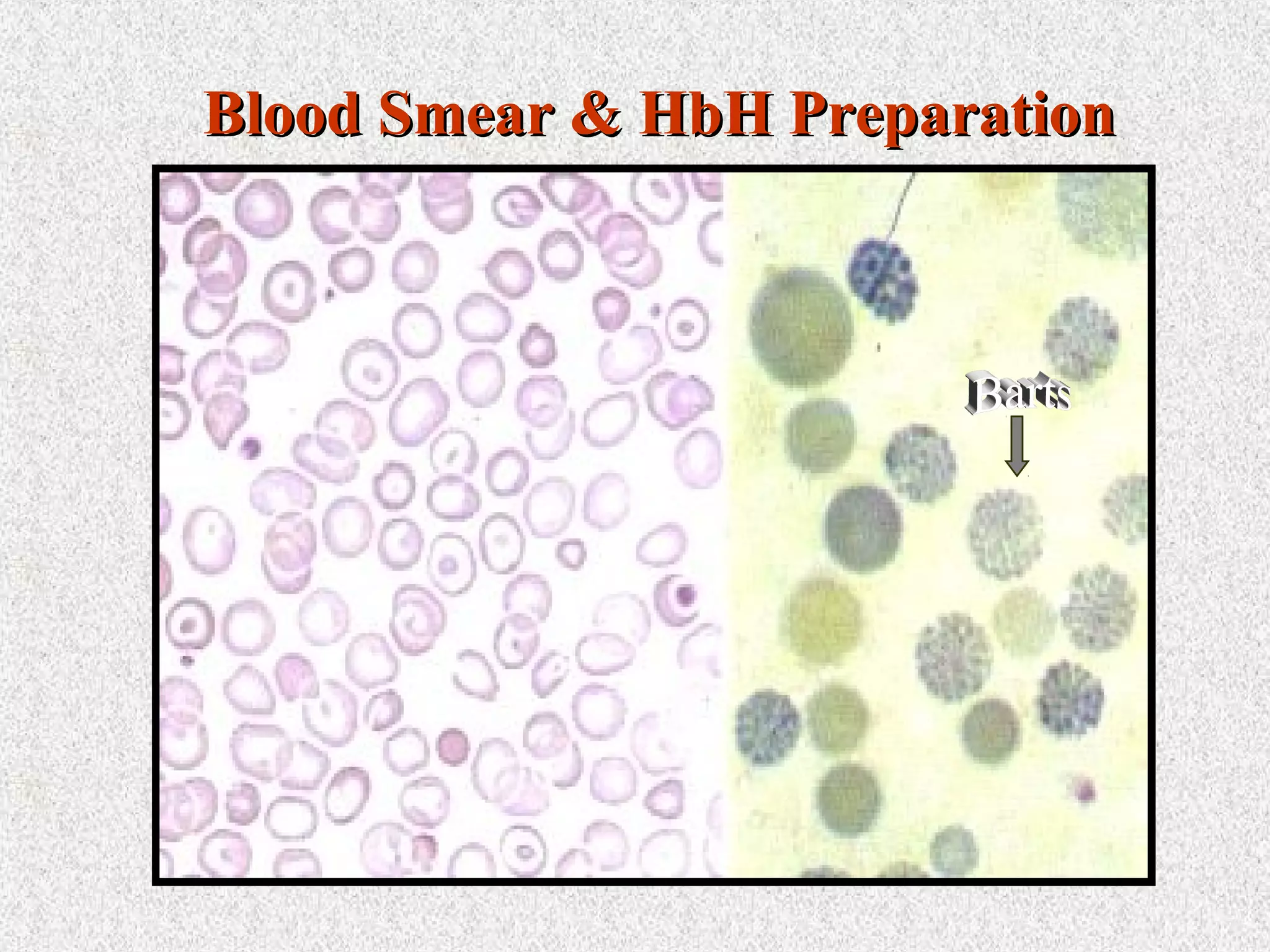 Blood Smear & HbH PreparationBlood Smear & HbH Preparation
 