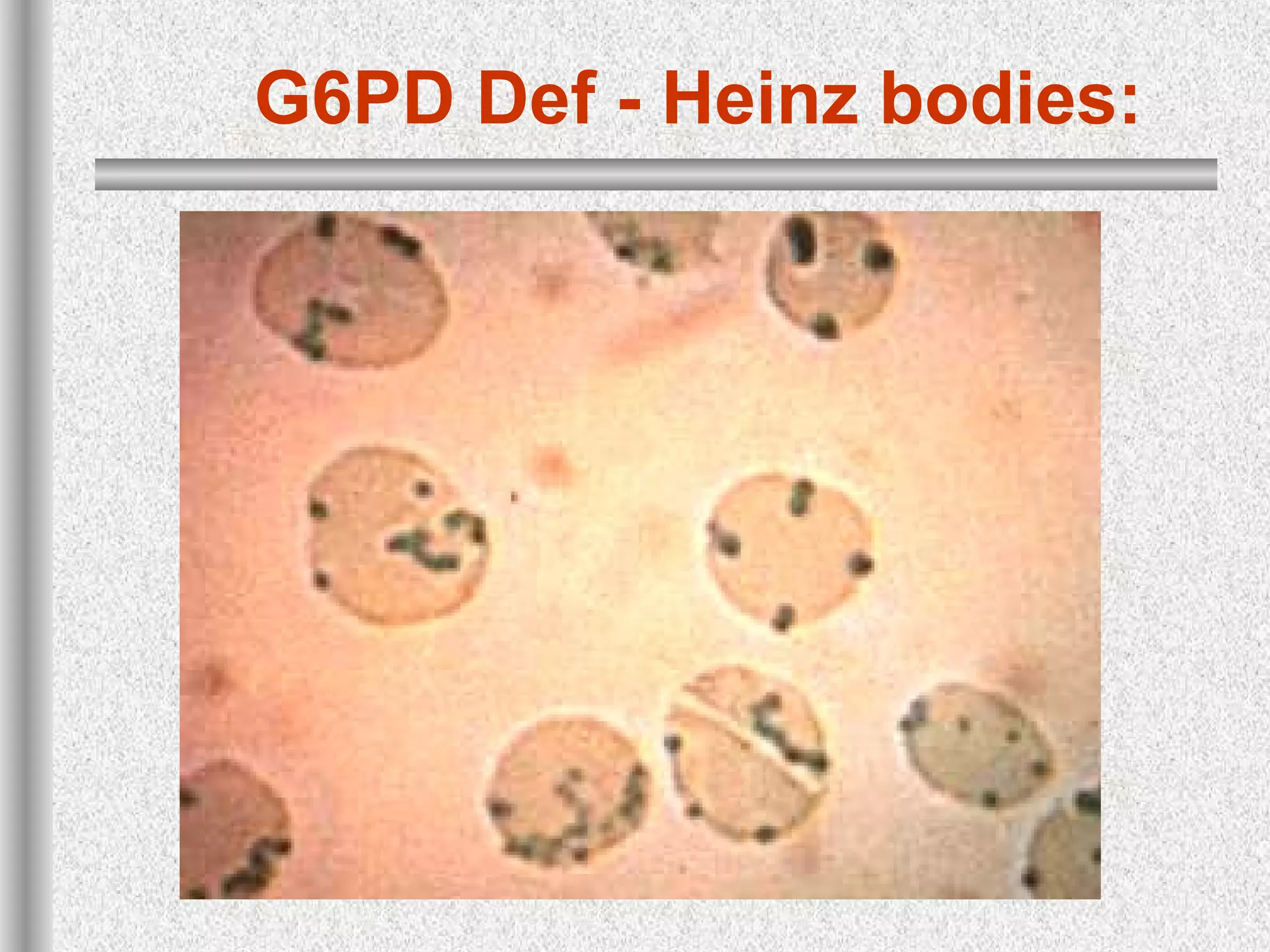 G6PD Def - Heinz bodies:
 