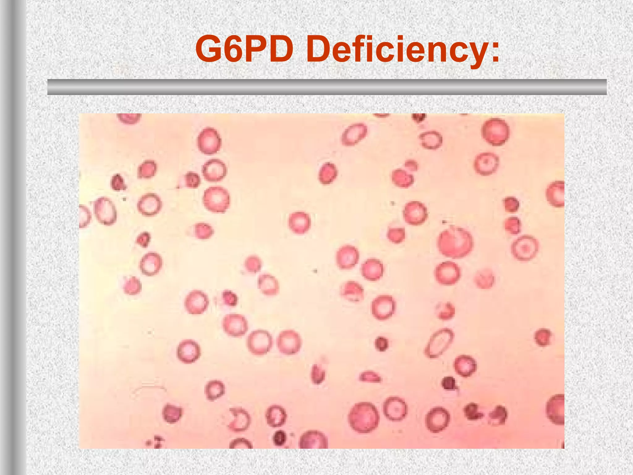G6PD Deficiency:
 