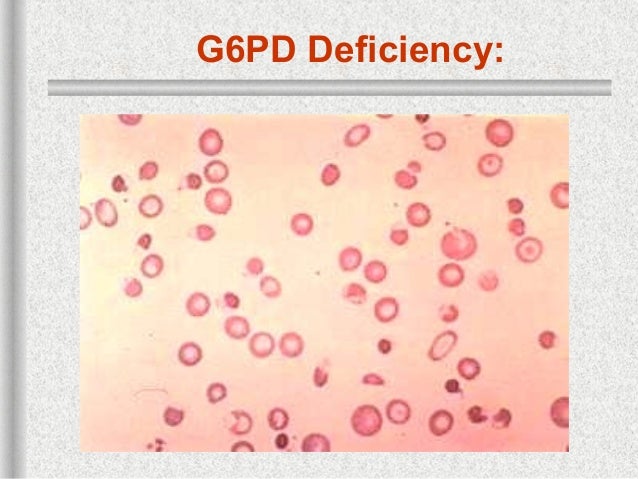 https://image.slidesharecdn.com/4a-hemolyticanemia-130420130636-phpapp02/95/hemolytic-anemia-1-37-638.jpg?cb=1366463238