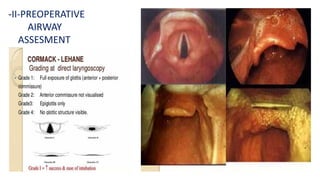 -II-PREOPERATIVE
AIRWAY
ASSESMENT
 