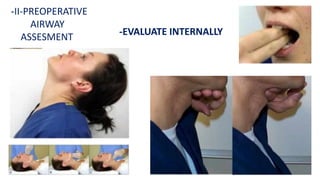 -II-PREOPERATIVE
AIRWAY
ASSESMENT -EVALUATE INTERNALLY
 