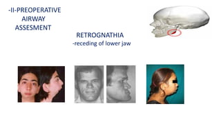 RETROGNATHIA
-receding of lower jaw
-II-PREOPERATIVE
AIRWAY
ASSESMENT
 
