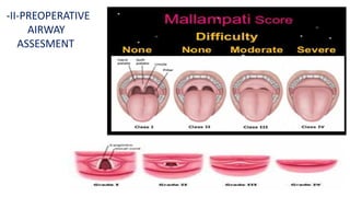 -II-PREOPERATIVE
AIRWAY
ASSESMENT
 