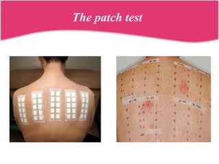 The patch test
 