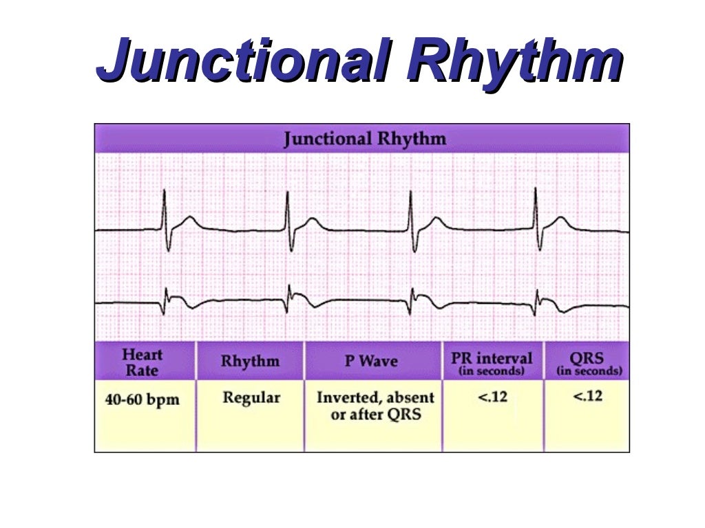 Junctional Rhythms BMH/Tele