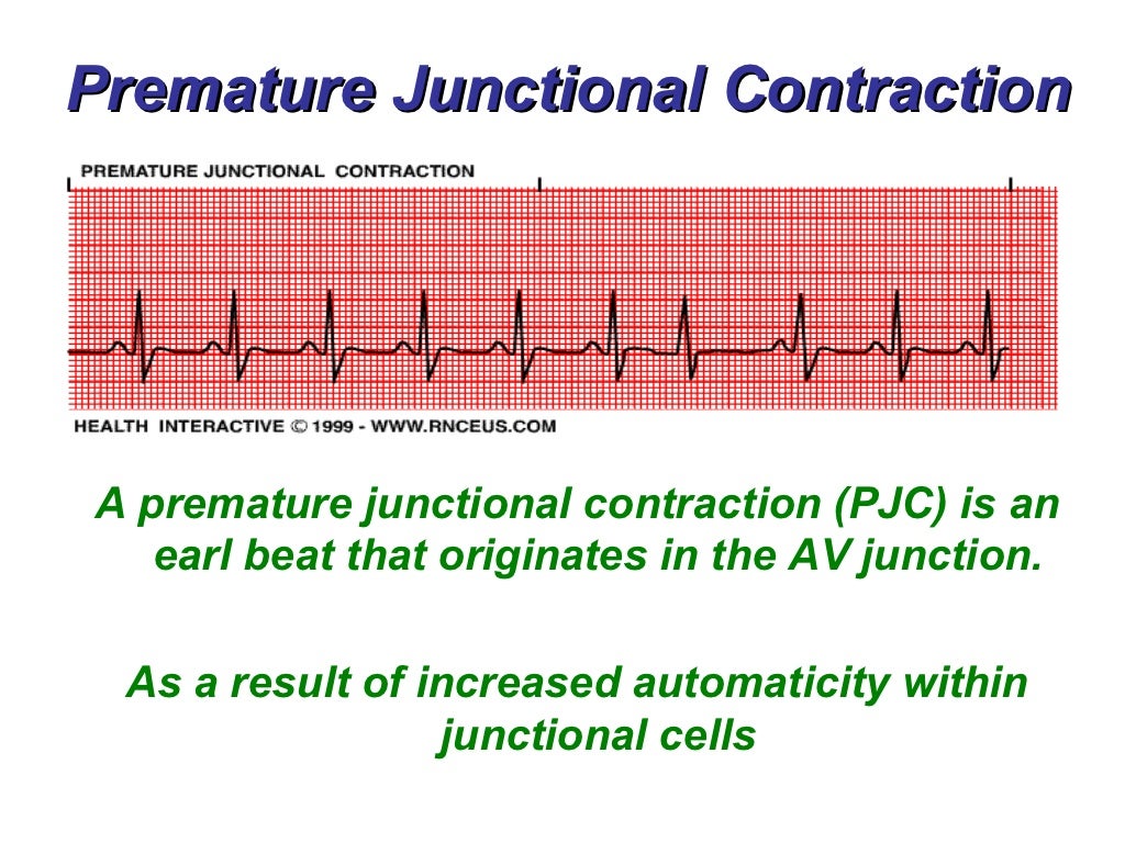 Junctional Rhythms BMH/Tele