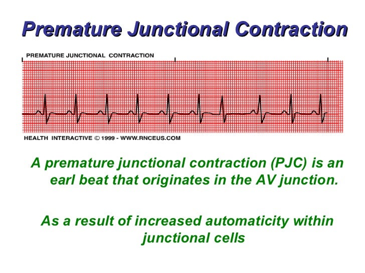 Junctional Rhythms Bmh Tele