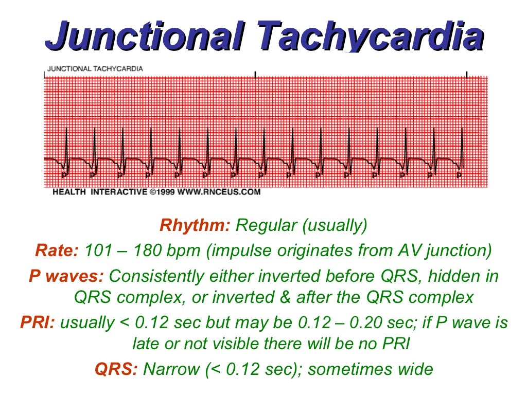 junctional-rhythms-bmh-tele