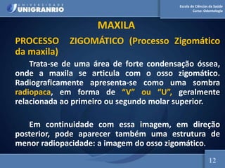 Escola de Ciências da Saúde
Curso: Odontologia
MAXILA
PROCESSO ZIGOMÁTICO (Processo Zigomático
da maxila)
Trata-se de uma área de forte condensação óssea,
onde a maxila se articula com o osso zigomático.
Radiograficamente apresenta-se como uma sombra
radiopaca, em forma de “V” ou “U”, geralmente
relacionada ao primeiro ou segundo molar superior.
Em continuidade com essa imagem, em direção
posterior, pode aparecer também uma estrutura de
menor radiopacidade: a imagem do osso zigomático.
12
 
