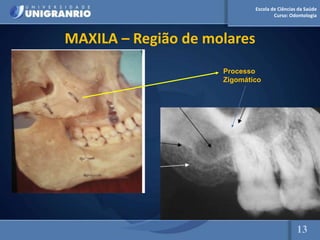 Escola de Ciências da Saúde
Curso: Odontologia
MAXILA – Região de molares
Processo
Zigomático
13
 