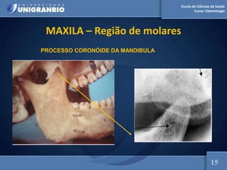 Escola de Ciências da Saúde
Curso: Odontologia
MAXILA – Região de molares
15
PROCESSO CORONÓIDE DA MANDIBULA
 