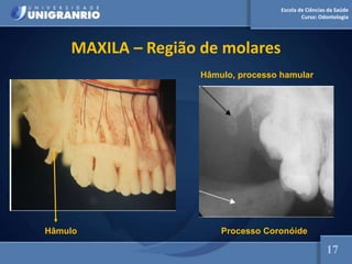 Escola de Ciências da Saúde
Curso: Odontologia
MAXILA – Região de molares
Hâmulo
17
Processo Coronóide
Hâmulo, processo hamular
 