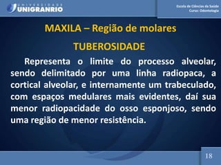 Escola de Ciências da Saúde
Curso: Odontologia
MAXILA – Região de molares
TUBEROSIDADE
Representa o limite do processo alveolar,
sendo delimitado por uma linha radiopaca, a
cortical alveolar, e internamente um trabeculado,
com espaços medulares mais evidentes, daí sua
menor radiopacidade do osso esponjoso, sendo
uma região de menor resistência.
18
 
