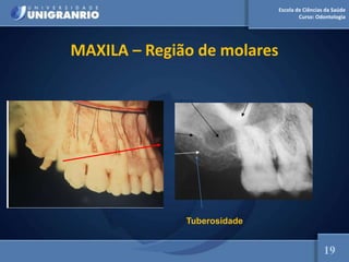 Escola de Ciências da Saúde
Curso: Odontologia
MAXILA – Região de molares
19
Tuberosidade
 