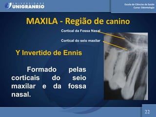 Escola de Ciências da Saúde
Curso: Odontologia
MAXILA - Região de canino
Cortical do seio maxilar
Cortical da Fossa Nasal
Y Invertido de Ennis
Formado pelas
corticais do seio
maxilar e da fossa
nasal.
22
 