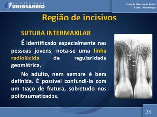 Escola de Ciências da Saúde
Curso: Odontologia
Região de incisivos
SUTURA INTERMAXILAR
É identificado especialmente nas
pessoas jovens; nota-se uma linha
radiolúcida de regularidade
geométrica.
No adulto, nem sempre é bem
definida. É possível confundi-la com
um traço de fratura, sobretudo nos
politraumatizados.
28
 