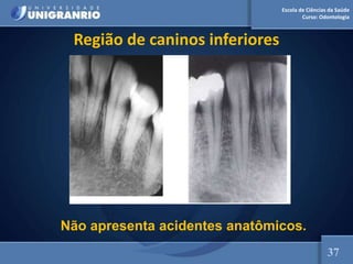 Escola de Ciências da Saúde
Curso: Odontologia
Região de caninos inferiores
Não apresenta acidentes anatômicos.
37
 