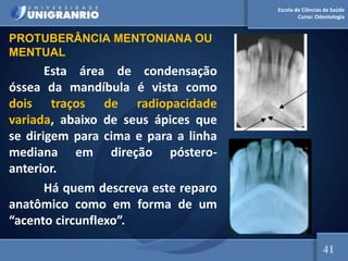 Escola de Ciências da Saúde
Curso: Odontologia
Esta área de condensação
óssea da mandíbula é vista como
dois traços de radiopacidade
variada, abaixo de seus ápices que
se dirigem para cima e para a linha
mediana em direção póstero-
anterior.
Há quem descreva este reparo
anatômico como em forma de um
“acento circunflexo”.
41
PROTUBERÂNCIA MENTONIANA OU
MENTUAL
 