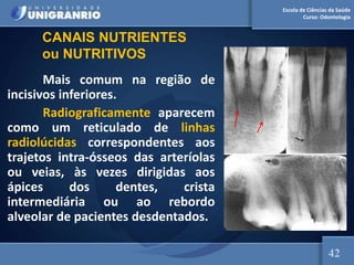 Escola de Ciências da Saúde
Curso: Odontologia
Mais comum na região de
incisivos inferiores.
Radiograficamente aparecem
como um reticulado de linhas
radiolúcidas correspondentes aos
trajetos intra-ósseos das arteríolas
ou veias, às vezes dirigidas aos
ápices dos dentes, crista
intermediária ou ao rebordo
alveolar de pacientes desdentados.
CANAIS NUTRIENTES
ou NUTRITIVOS
42
 
