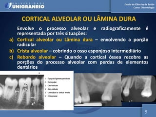 Escola de Ciências da Saúde
Curso: Odontologia
CORTICAL ALVEOLAR OU LÂMINA DURA
Envolve o processo alveolar e radiograficamente é
representada por três situações:
a) Cortical alveolar ou Lâmina dura – envolvendo a porção
radicular
b) Crista alveolar – cobrindo o osso esponjoso intermediário
c) Rebordo alveolar – Quando a cortical óssea recobre as
porções do processo alveolar com perdas de elementos
dentários
1. Espaço do ligamento periodontal
2. Corno pulpar
3. Canal radicular
4. Ápice radicular
5. Lâmina dura ou cortical alveolar
6. Crista alveolar
6
5
 