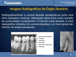 Escola de Ciências da Saúde
Curso: Odontologia
Imagens Radiográficas do Órgão Dentário
Radiograficamente a cortical alveolar apresenta-se como uma
linha radiopaca contínua. Alterações desta linha como solução
de continuidade (rompimento) a nível de crista alveolar, é sinal
radiográfico indicativo de periodontopatias, e à nível apical são
indícios de lesões periapicais.
1. Espaço do ligamento periodontal
2. Corno pulpar
3. Canal radicular
4. Ápice radicular
5. Lâmina dura ou cortical alveolar
6. Crista alveolar
6
6
 