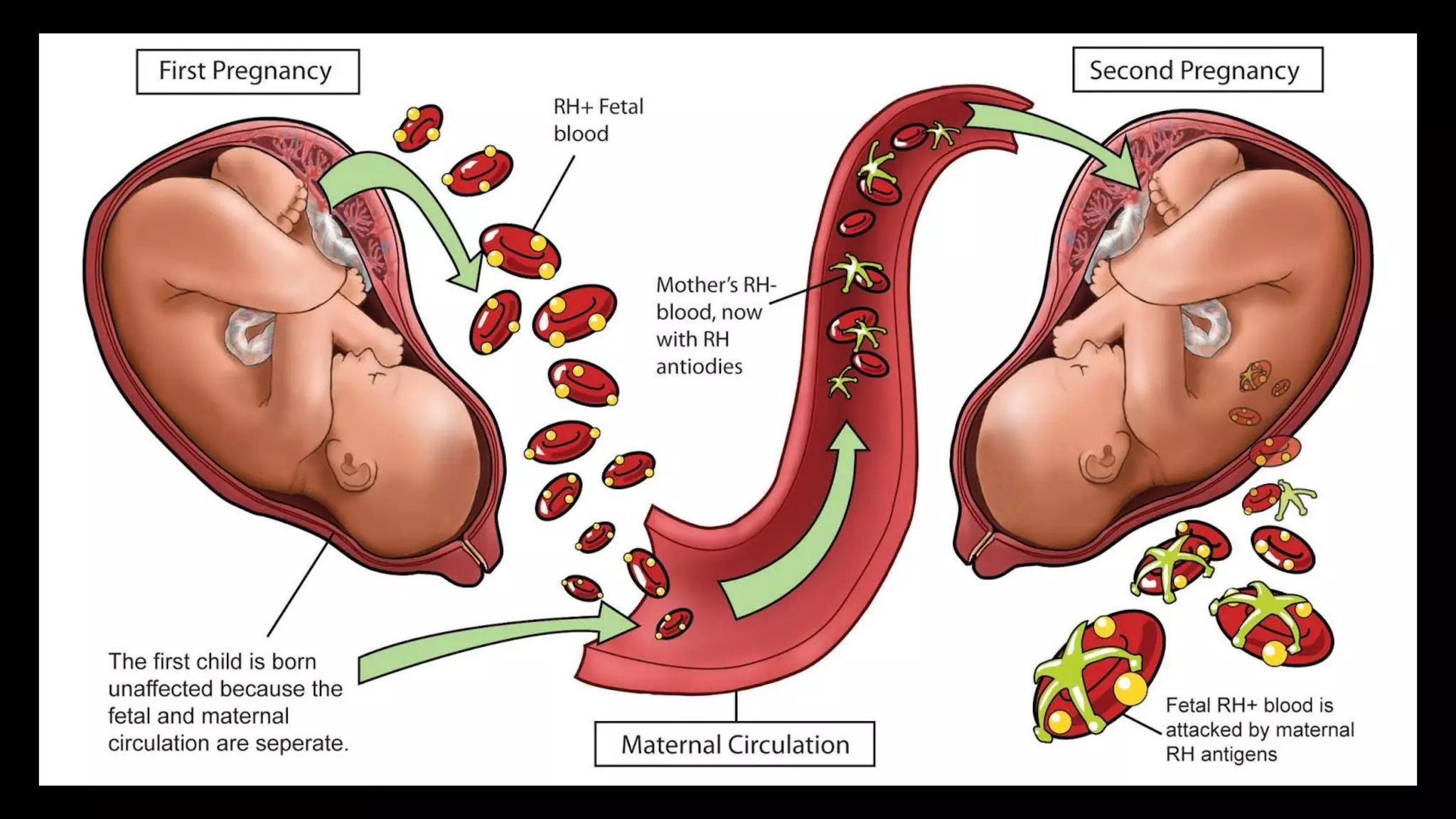 Blood cell
transfusion
for Fetus
 