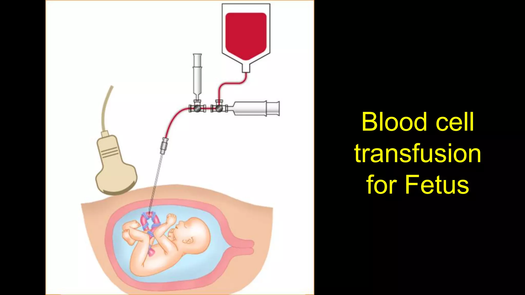Blood cell
transfusion
for Fetus
 