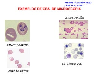 EXEMPLOS DE OBS. DE MICROSCOPIA
HEMATOZOARIOS
CORP. DE HEINZ
AGLUTINAÇÃO
ESFEROCITOSE
ANEMIAS – CLASSIFICAÇÃO
QUANTO A CAUSA
 