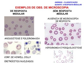 EXEMPLOS DE OBS. DE MICROSCOPIA
DE RESPOSTA
MEDULAR
SEM RESPOSTA
MEDULAR
ANISOCITOSE E POLICROMASIA
CORP. DE HOWELL JOLLY
ERITRÓCITOS NUCLEADOS
AUSENCIA DE MICROSCOPIA
DE RESPOSTA
HIPOCROMIA E POIQUILOCITOSE
ANEMIAS – CLASSIFICAÇÃO
QUANTO A RESPOSTA MEDULAR
 