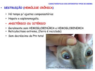  DESTRUIÇÃO (HEMÓLISE CRÔNICA)
 Há tempo p/ ajustes compensatórios
 Hepato e esplenomegalia.
 ANICTÉRICO OU ICTÉRICO
 Geralmente sem HEMOGLOBINÚRIA e HEMOGLOBINEMIA
 Reticulocitose extrema, (ferro é reciclado)
 Sem decréscimo da Ptn total
CARACTERÍSTICAS DOS DIFERENTES TIPOS DE ANEMIA
Imagem: Dra Marcia Salomão
 