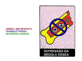 ANEMIA SEM RESPOSTA
TROMBOCITOPENIA
LEUCOPENIA MADURA
 