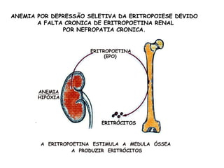 ANEMIA POR DEPRESSÃO SELETIVA DA ERITROPOIESE DEVIDO
A FALTA CRONICA DE ERITROPOETINA RENAL
POR NEFROPATIA CRONICA.
 