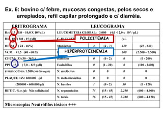 Ex. 6: bovino c/ febre, mucosas congestas, pelos secos e
arrepiados, refil capilar prolongado e c/ diarréia.
ERITROGRAMA LEUCOGRAMA
He: 13 (5,0 – 10,0 X 106/µL) LEUCOMETRIA GLOBAL: 3.000 (4,0 -12,0 x 103 / µL)
Hb: 18 ( 8,0 - 15 g/dl) C. DIFERENCIAL % /µL
Ht: 54 ( 24 - 46%) Monócitos 4 (2 - 7) 120 (25 - 840)
VCM: 41,5 (40 - 60 fl) Linfócitos 20 (45 - 75) 600 (2.500 – 7.500)
CHCM: 33 (30 - 36%) Basófilos 0 (0 - 2) 0 (0 - 200)
PPT: 13,0 ( 7,0 – 8,5 g/dl) Eosinófilos 0 (1 - 20) 0 (100 - 2400)
FIBRINOGÊNIO: 1.500 (300-700 mg/dl) N. mielócitos 0 0 0 0
PLAQUETAS: 600.000 /µl N. metamielócitos 0 0 0 0
(200000 - 600.000/µl) N. bastões 1 (0 - 2) 30 (0 - 120)
RETIC. % e /µl: Não solicitado! N. segmentados 75 (15 - 45) 2.250 (600 – 4.000)
N. totais 76 (15 - 47) 2.280 (600 – 4.120)
Microscopia: Neutrófilos tóxicos +++
POLICITEMIA
HIPERPROTEINEMIA
 