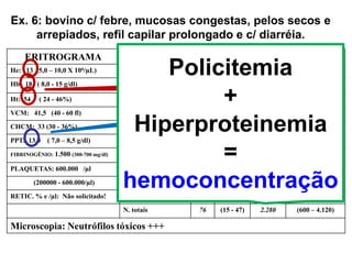 Ex. 6: bovino c/ febre, mucosas congestas, pelos secos e
arrepiados, refil capilar prolongado e c/ diarréia.
ERITROGRAMA LEUCOGRAMA
He: 13 (5,0 – 10,0 X 106/µL) LEUCOMETRIA GLOBAL: 3.000 (4,0 -12,0 x 103 / µL)
Hb: 18 ( 8,0 - 15 g/dl) C. DIFERENCIAL % /µL
Ht: 54 ( 24 - 46%) Monócitos 4 (2 - 7) 120 (25 - 840)
VCM: 41,5 (40 - 60 fl) Linfócitos 20 (45 - 75) 600 (2.500 – 7.500)
CHCM: 33 (30 - 36%) Basófilos 0 (0 - 2) 0 (0 - 200)
PPT: 13,0 ( 7,0 – 8,5 g/dl) Eosinófilos 0 (1 - 20) 0 (100 - 2400)
FIBRINOGÊNIO: 1.500 (300-700 mg/dl) N. mielócitos 0 0 0 0
PLAQUETAS: 600.000 /µl N. metamielócitos 0 0 0 0
(200000 - 600.000/µl) N. bastões 1 (0 - 2) 30 (0 - 120)
RETIC. % e /µl: Não solicitado! N. segmentados 75 (15 - 45) 2.250 (600 – 4.000)
N. totais 76 (15 - 47) 2.280 (600 – 4.120)
Microscopia: Neutrófilos tóxicos +++
POLICITEMIA
HIPERPROTEINEMIA
Policitemia
+
Hiperproteinemia
=
hemoconcentração
 