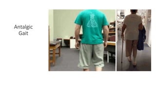 Antalgic
Gait
 