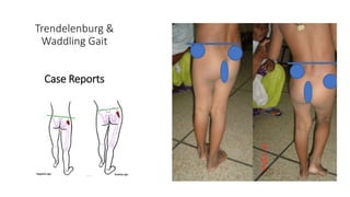 Trendelenburg &
Waddling Gait
Case Reports
 