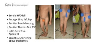 Case 1:TRENDELENBERG GAIT
• 6m-old H/O fall
• Antalgic Limp left hip
• Positive Trendelenburg
• Positive Thomas Test 150
• LLD 1.5cm True.
Apparent
• Bryant’s.. Shortening
above trochanter.
 