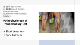 Pathophysiology of
Trendelenburg Test
•Short Lever Arm
•Poor Fulcrum
@ 18 m post trauma
i.e 12/12m post fixation.
Implant removed.
NON-Union Fremoral Neck
Fracture
 