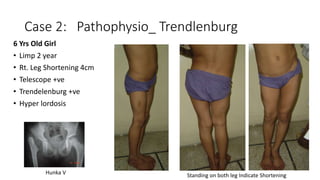 Case 2: Pathophysio_ Trendlenburg
6 Yrs Old Girl
• Limp 2 year
• Rt. Leg Shortening 4cm
• Telescope +ve
• Trendelenburg +ve
• Hyper lordosis
Standing on both leg Indicate ShorteningHunka V
 
