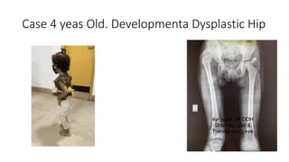 Case 4 yeas Old. Developmenta Dysplastic Hip
 